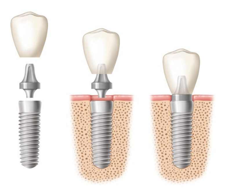 آشنایی با اجزای مختلف ایمپلنت دندان